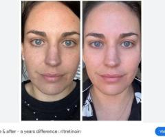 Tretinoin Lietuva